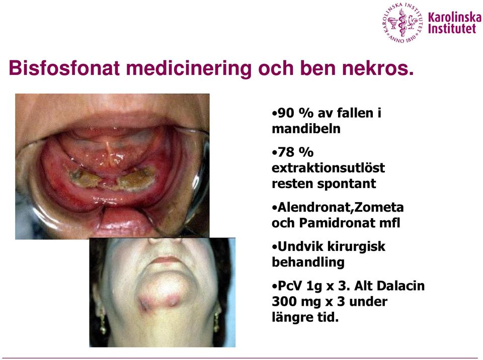 resten spontant Alendronat,Zometa och Pamidronat mfl