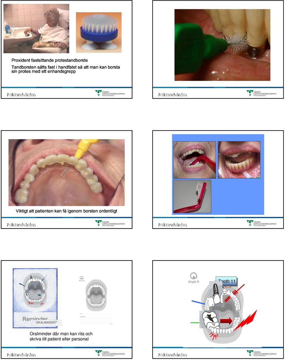 Viktigt att patienten kan få igenom borsten ordentligt Tooth 11