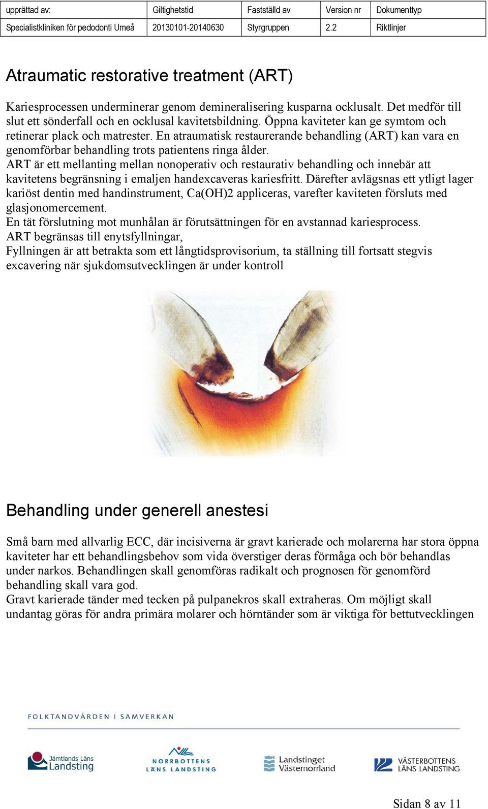 ART är ett mellanting mellan nonoperativ och restaurativ behandling och innebär att kavitetens begränsning i emaljen handexcaveras kariesfritt.