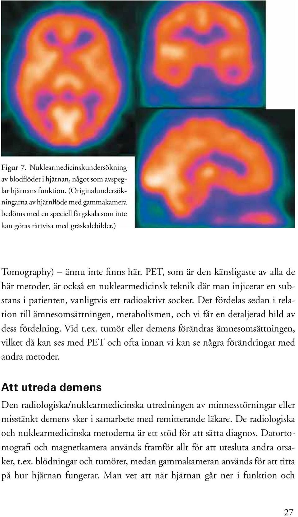 PET, som är den känsligaste av alla de här metoder, är också en nuklearmedicinsk teknik där man injicerar en substans i patienten, vanligtvis ett radioaktivt socker.