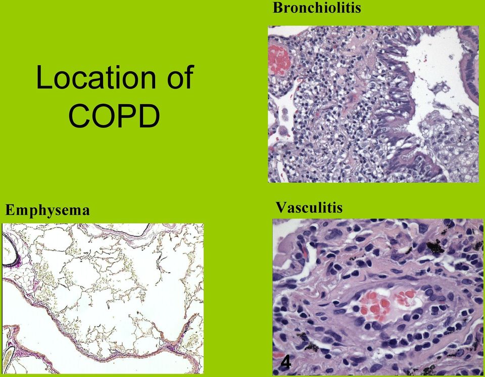 COPD