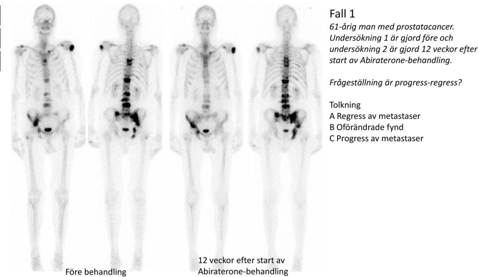 av Abiraterone-behandling. Frågeställning är progress-regress?