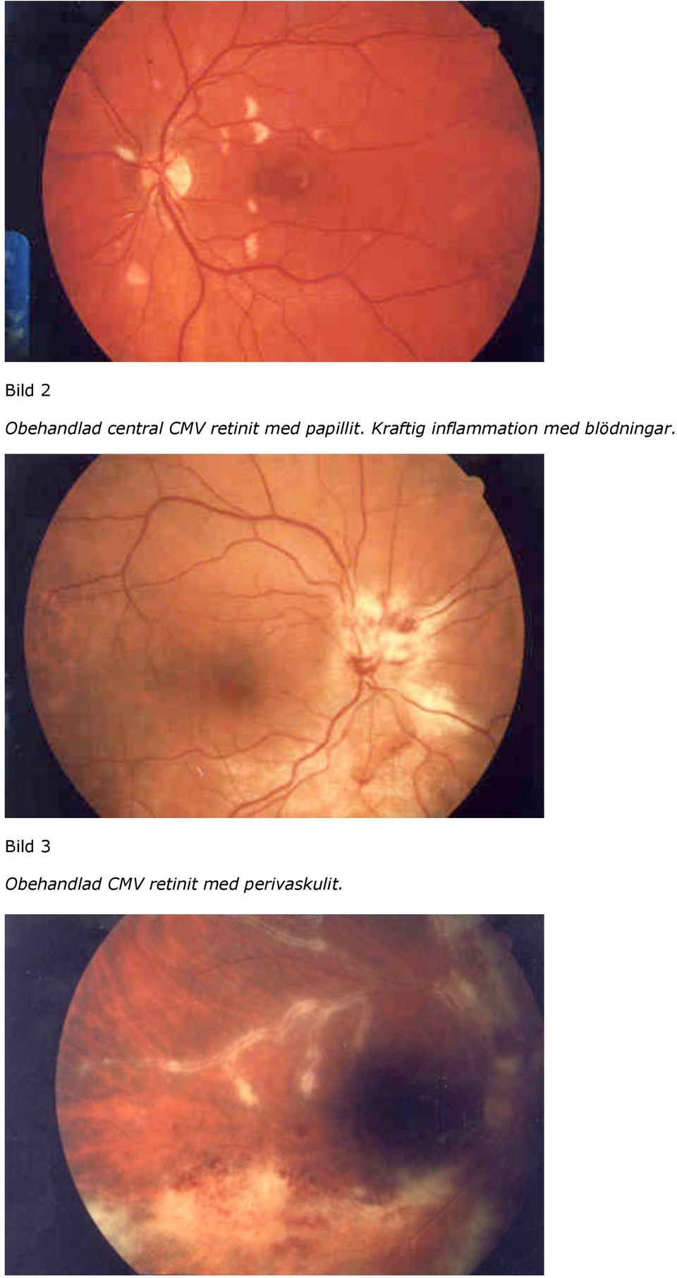 vaginal inflammation obehandlad