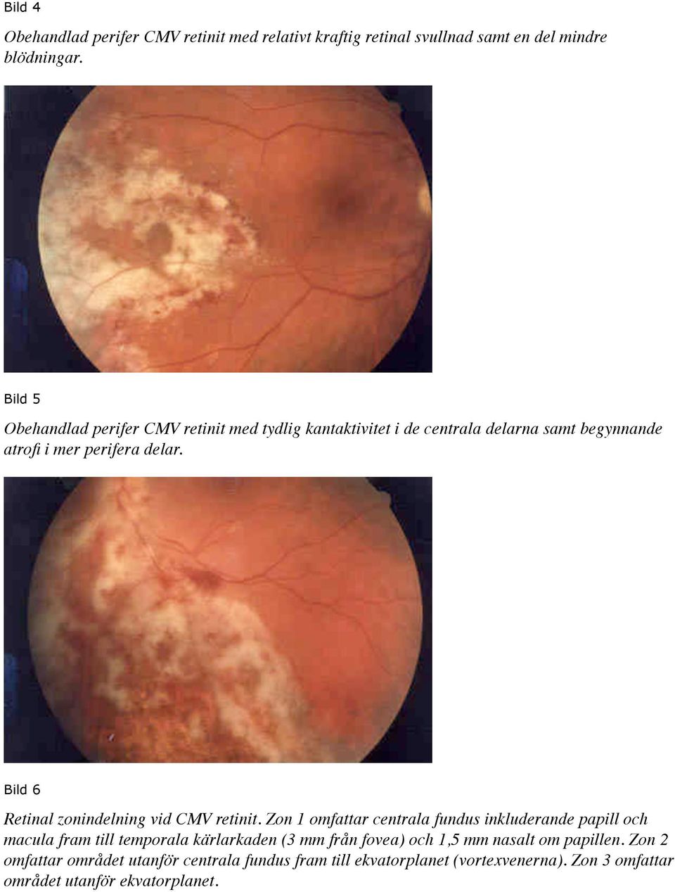 Bild 6 Retinal zonindelning vid CMV retinit.