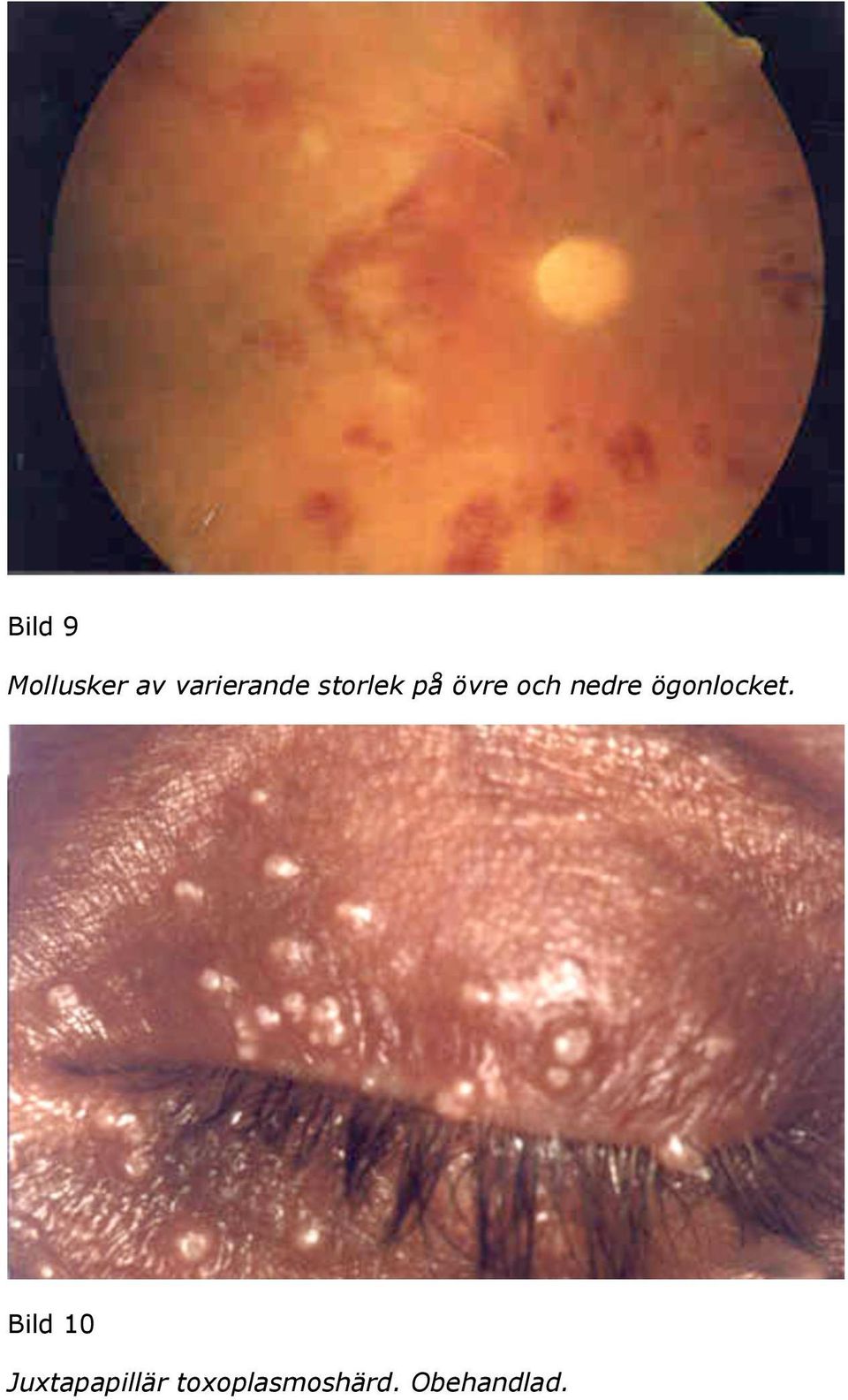 och nedre ögonlocket.
