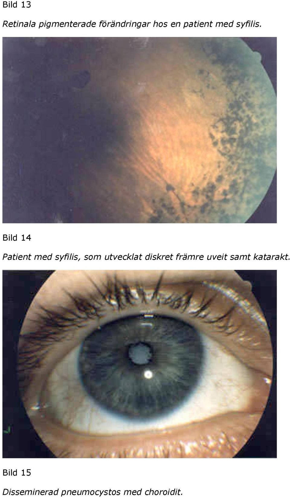 Bild 14 Patient med syfilis, som utvecklat