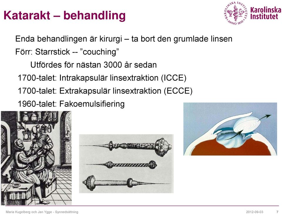 Intrakapsulär linsextraktion (ICCE) 1700-talet: Extrakapsulär linsextraktion