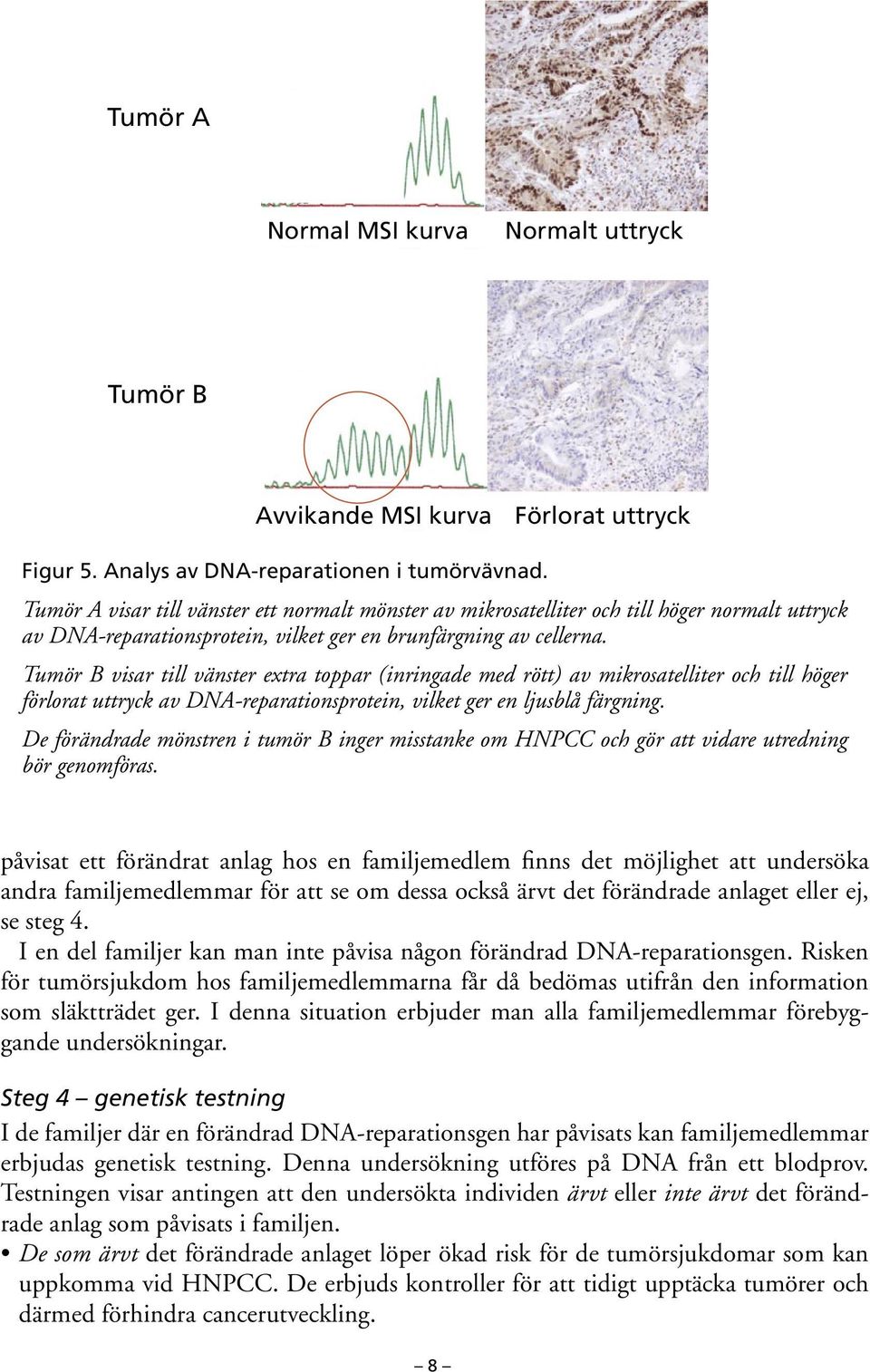 Tumör A visar till vänster ett normalt mönster av mikrosatelliter och till höger normalt uttryck av DNA-reparationsprotein, vilket ger en brunfärgning av cellerna.