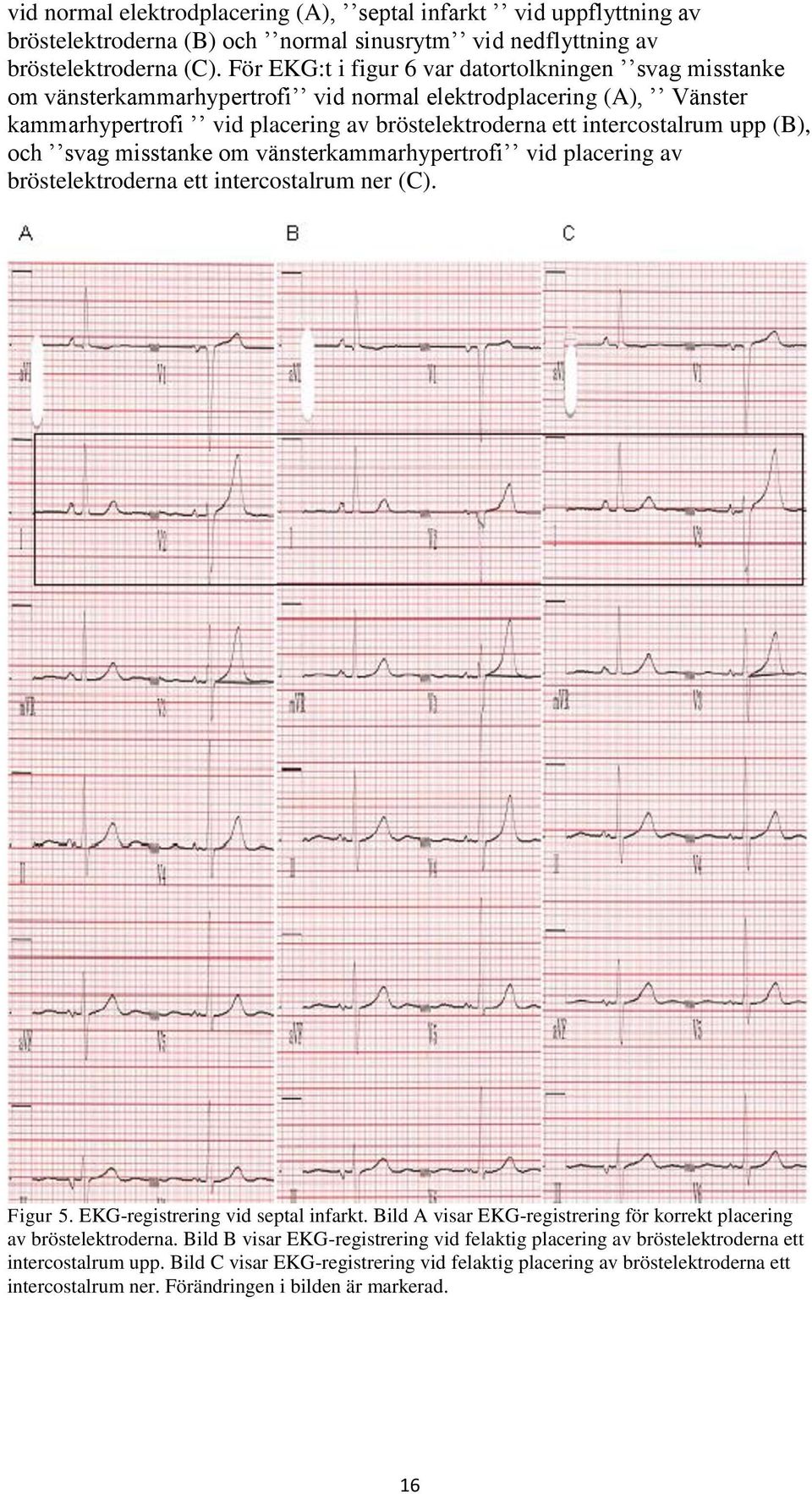 (B), och svag misstanke om vänsterkammarhypertrofi vid placering av bröstelektroderna ett intercostalrum ner (C). Figur 5. EKG-registrering vid septal infarkt.