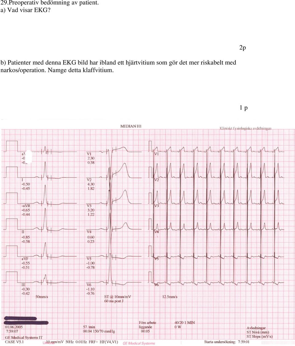 b) Patienter med denna EKG bild har ibland ett
