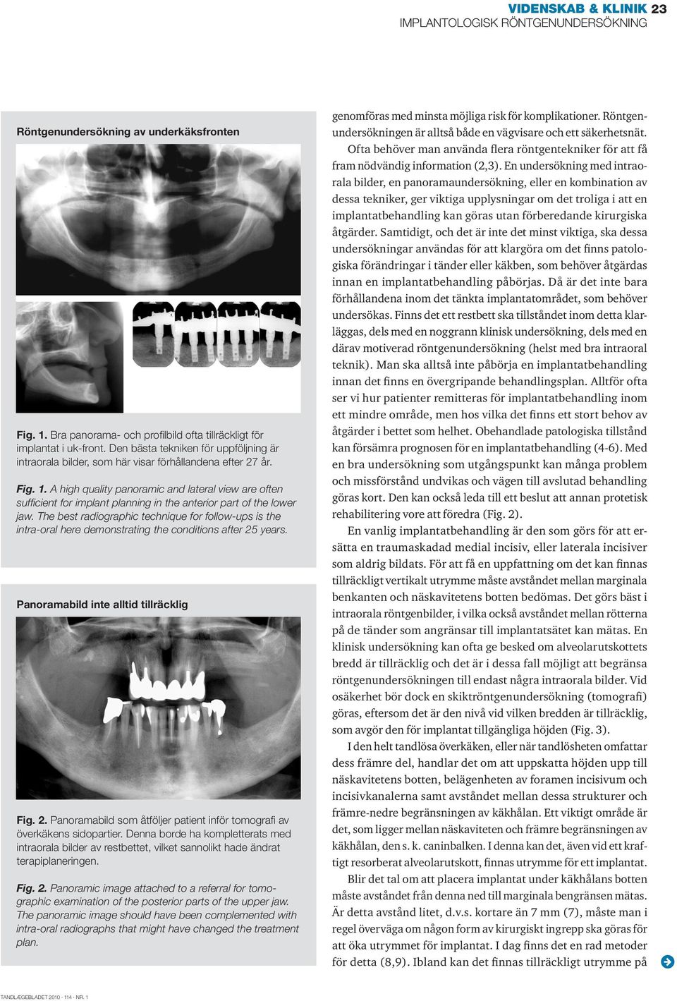 A high quality panoramic and lateral view are often sufficient for implant planning in the anterior part of the lower jaw.