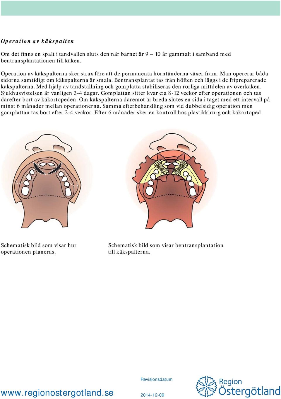 Bentransplantat tas från höften och läggs i de fripreparerade käkspalterna. Med hjälp av tandställning och gomplatta stabiliseras den rörliga mittdelen av överkäken.