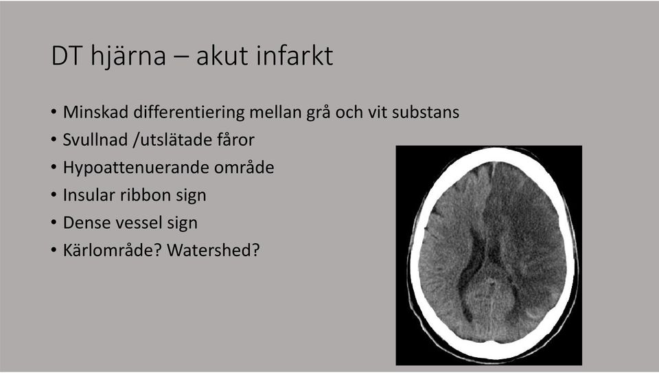 /utslätade fåror Hypoattenuerande område