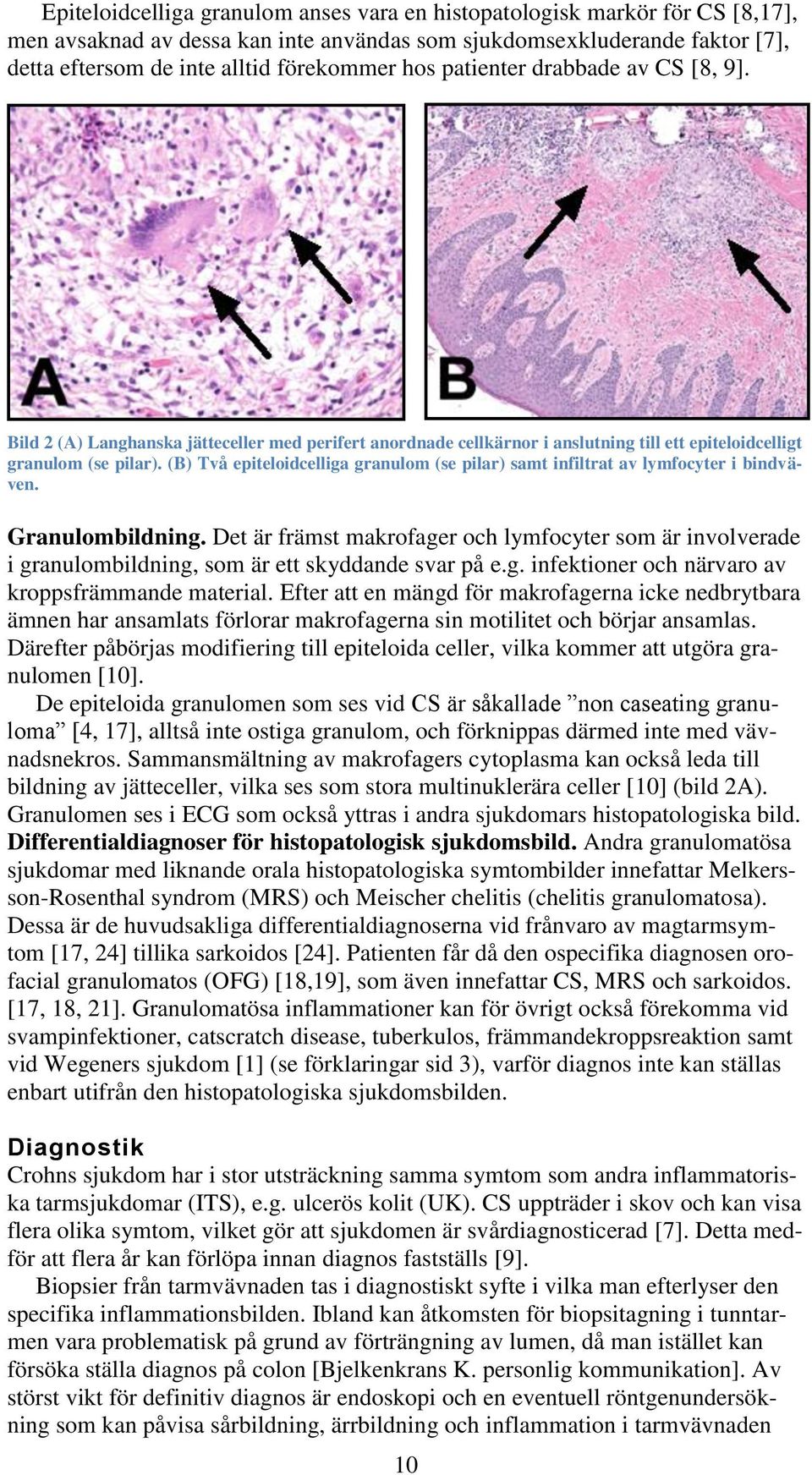 (B) Två epiteloidcelliga granulom (se pilar) samt infiltrat av lymfocyter i bindväven. Granulombildning.