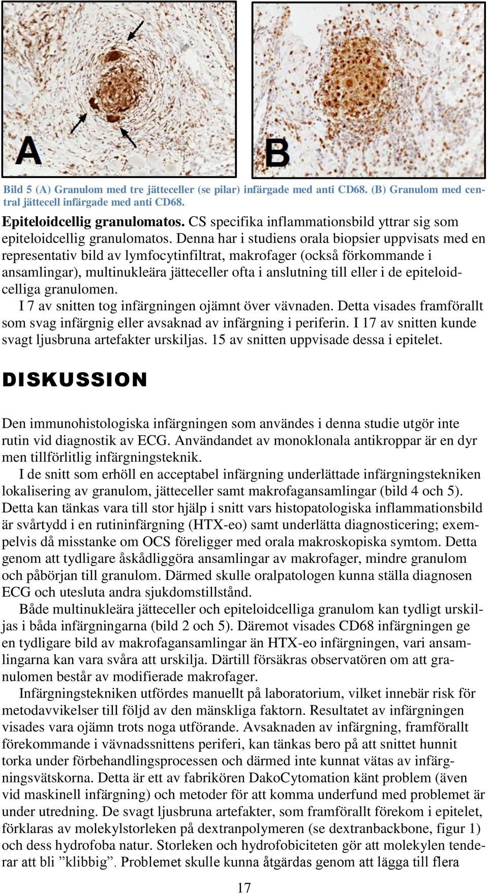 Denna har i studiens orala biopsier uppvisats med en representativ bild av lymfocytinfiltrat, makrofager (också förkommande i ansamlingar), multinukleära jätteceller ofta i anslutning till eller i de