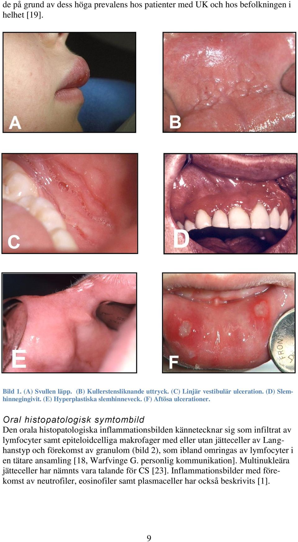 Oral histopatologisk symtombild Den orala histopatologiska inflammationsbilden kännetecknar sig som infiltrat av lymfocyter samt epiteloidcelliga makrofager med eller utan jätteceller av