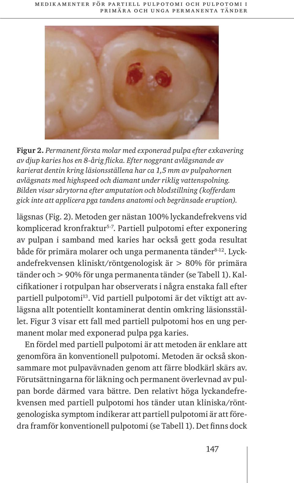 Bilden visar sårytorna efter amputation och blodstillning (kofferdam gick inte att applicera pga tandens anatomi och begränsade eruption). lägsnas (Fig. 2).