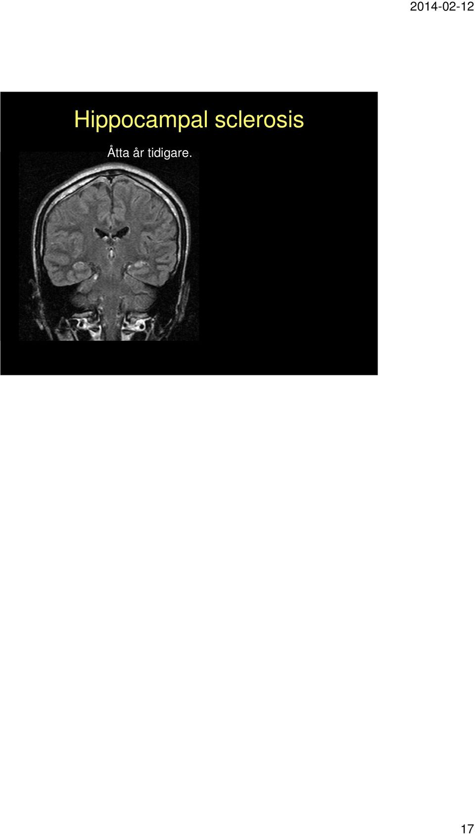 Parallellt med hippocampus, längs