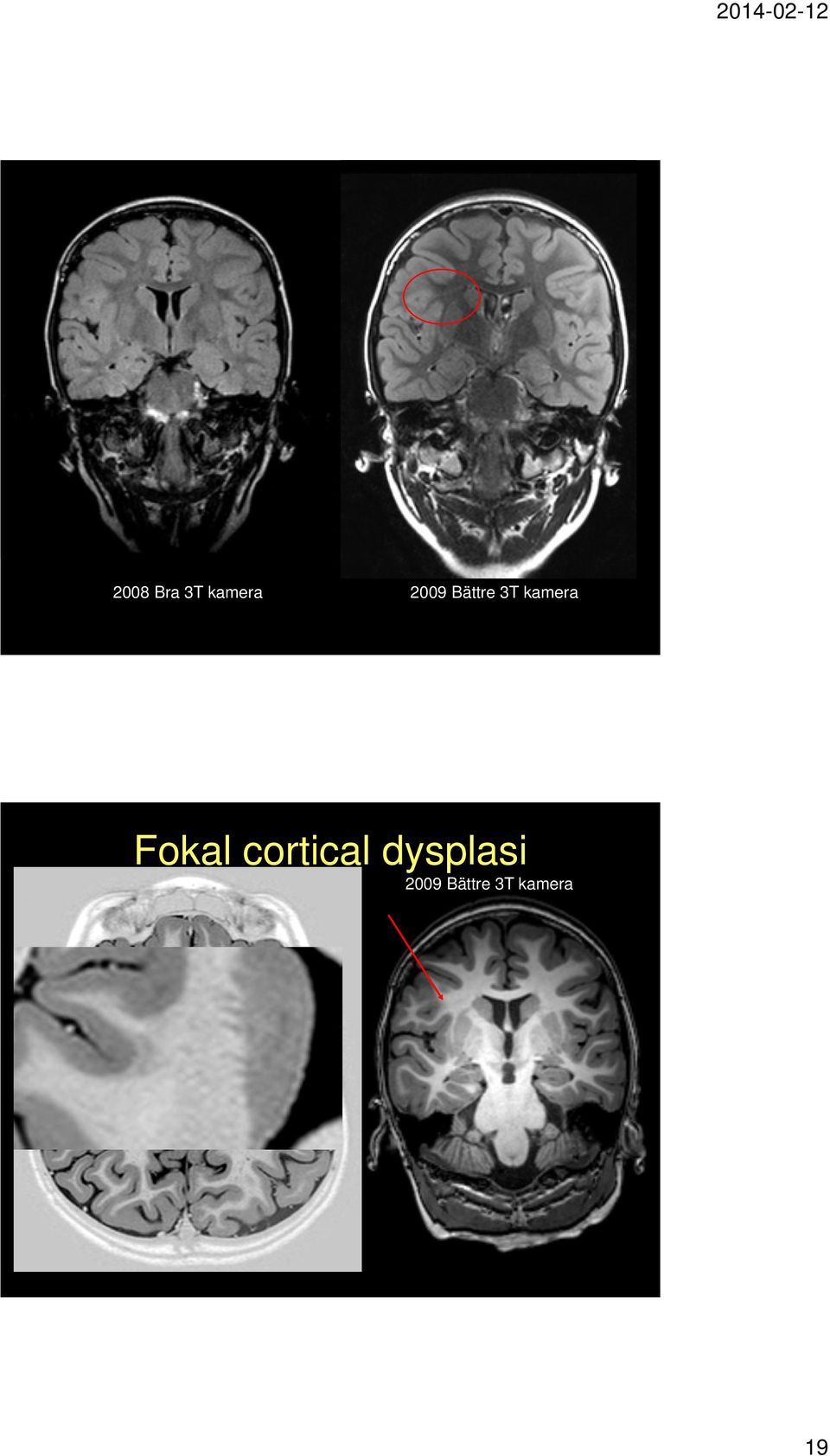 Fokal cortical