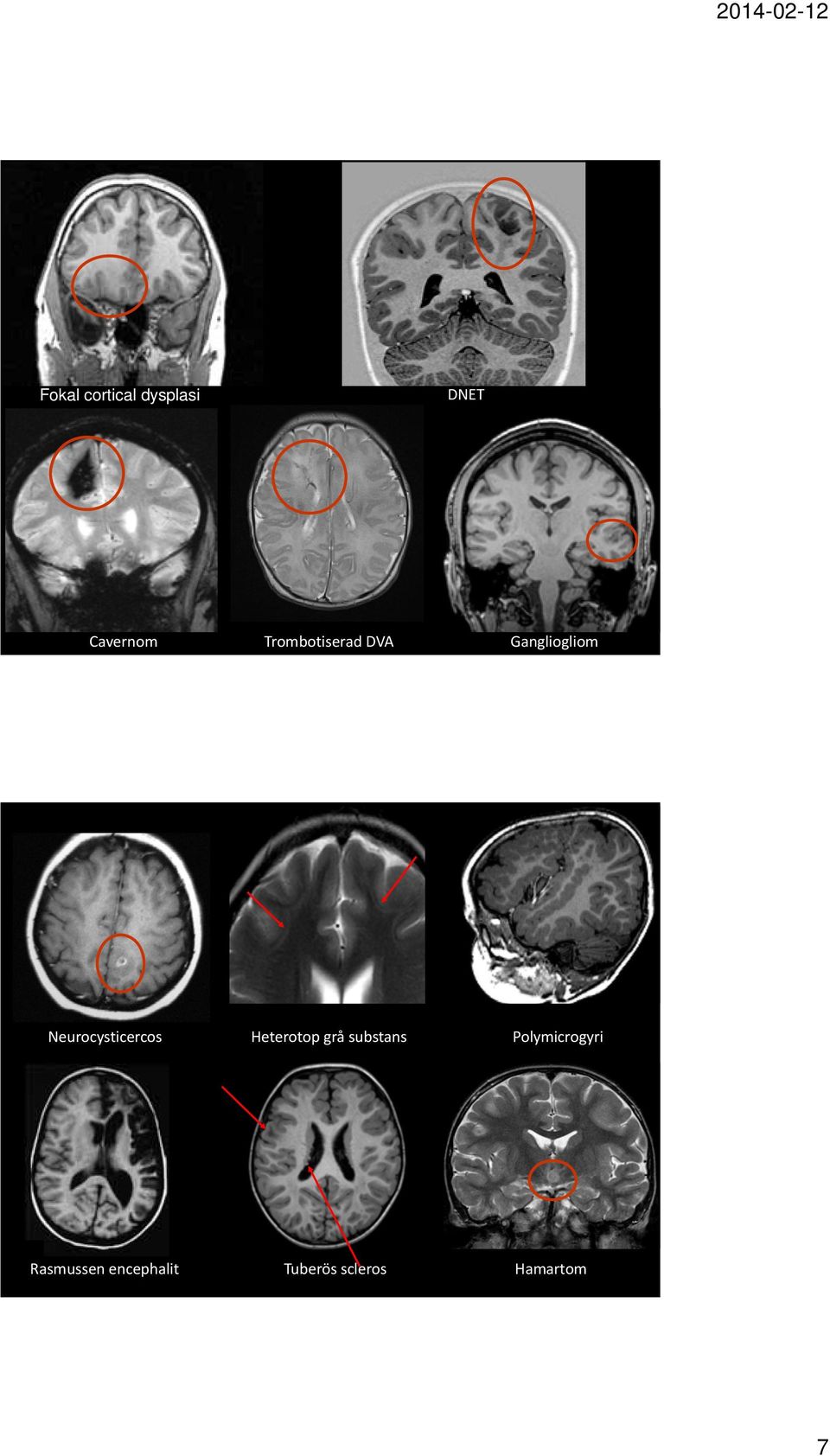 Neurocysticercos Heterotop grå substans