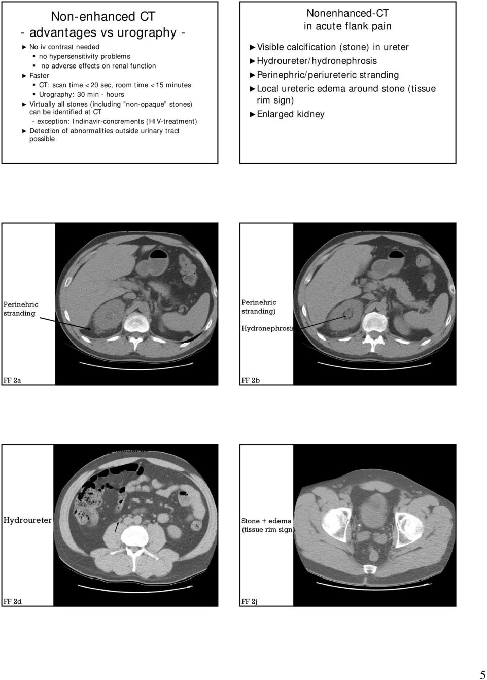 Nonenhanced-CT in acute flank pain Visible Visible calcification (stone) in ureter Hydroureter/hydronephrosis Perinephric/periuretericperiureteric stranding LocalLocal ureteric edema around stone