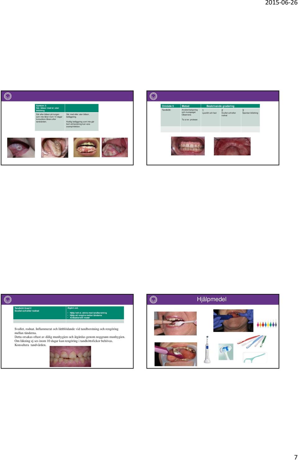 Ljusrött och fast Svullet och/eller rodnat Spontan blödning Hjälpmedel Tandkött Grad Svullet och/eller rodnat Åtgärd avd. Hjälp helt el.