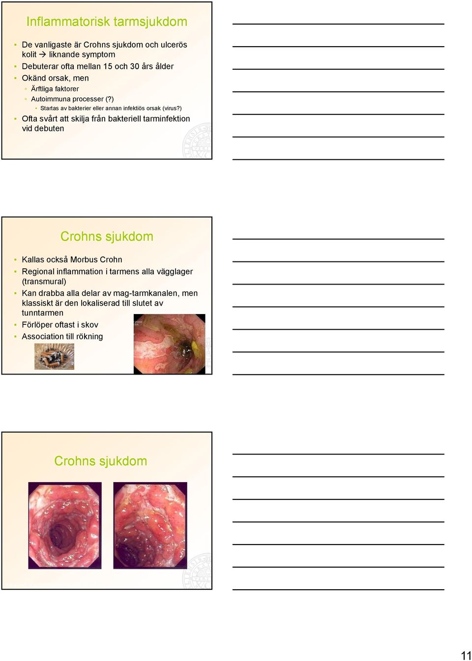 ) Ofta svårt att skilja från bakteriell tarminfektion vid debuten Crohns sjukdom Kallas också Morbus Crohn Regional inflammation i tarmens alla vägglager