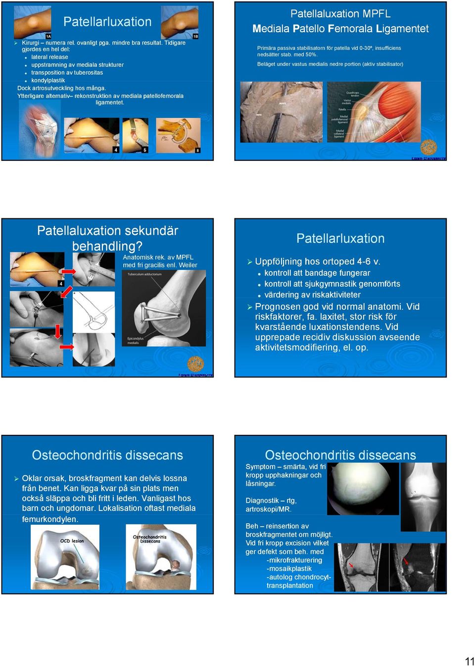 Ytterligare alternativ rekonstruktion av mediala patellofemorala ligamentet.