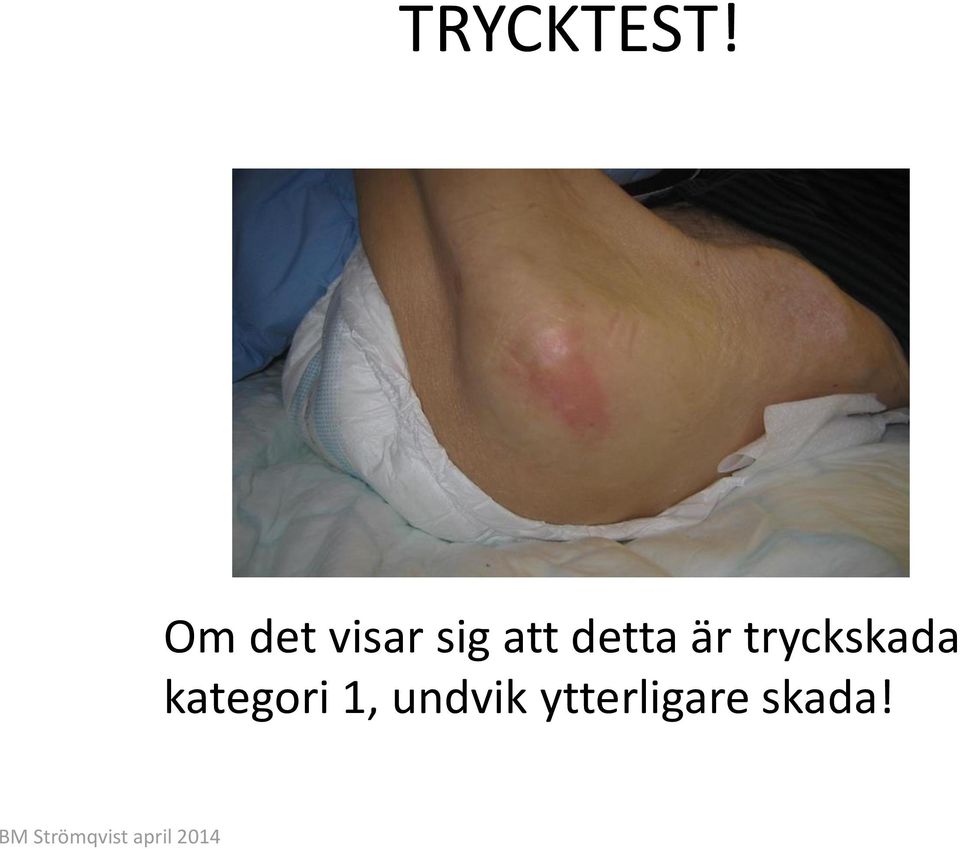 detta är tryckskada