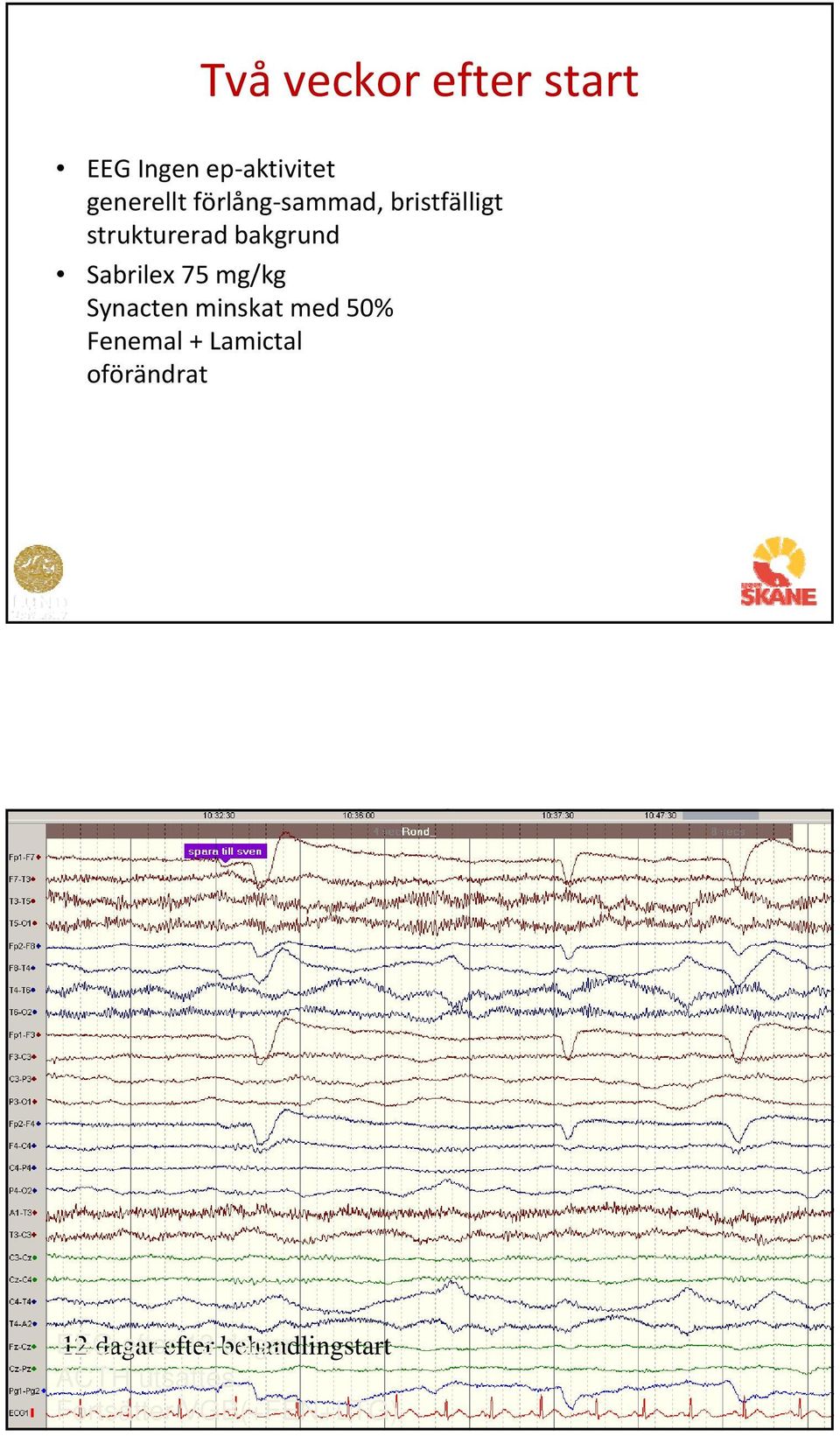 Synacten minskat med 50% Fenemal + Lamictal oförändrat 12 dagar