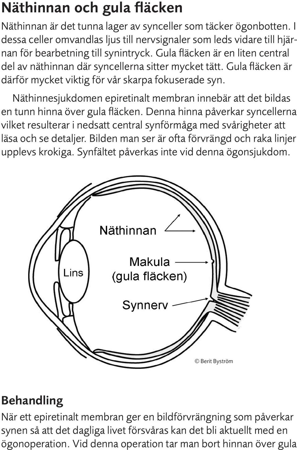 Gula fläcken är därför mycket viktig för vår skarpa fokuserade syn. Näthinnesjukdomen epiretinalt membran innebär att det bildas en tunn hinna över gula fläcken.