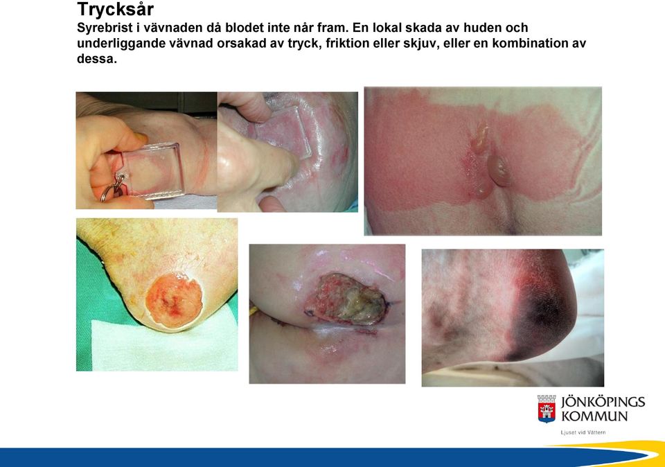 En lokal skada av huden och underliggande