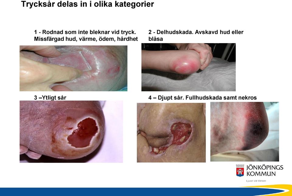 Missfärgad hud, värme, ödem, hårdhet 2 -
