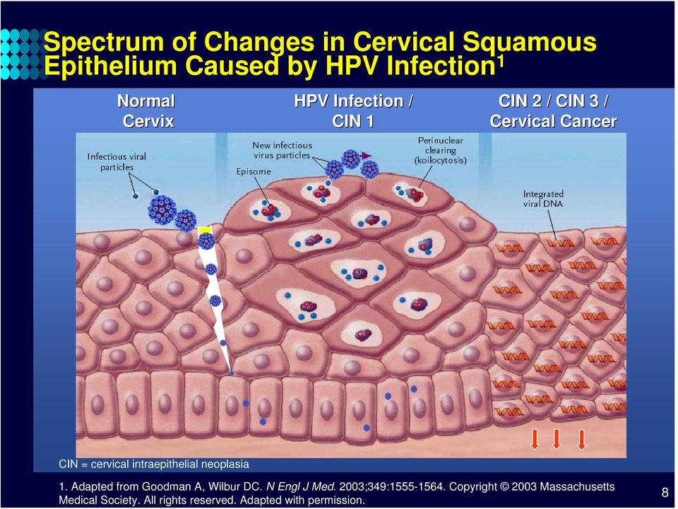 intraepithelial neoplasia 1. Adapted from Goodman A, Wilbur DC. N Engl J Med.