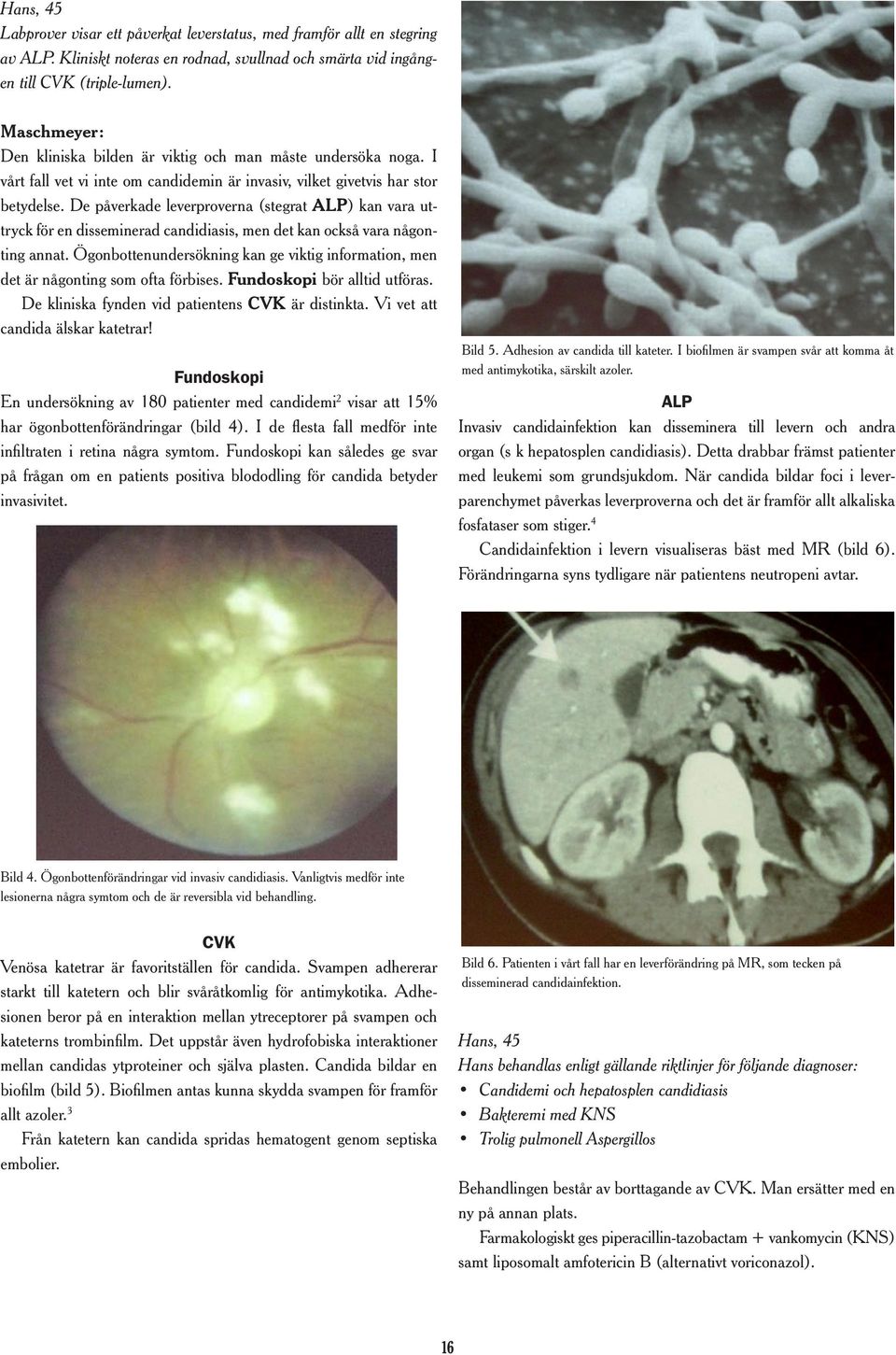 De påverkade leverproverna (stegrat ALP) kan vara uttryck för en disseminerad candidiasis, men det kan också vara någonting annat.