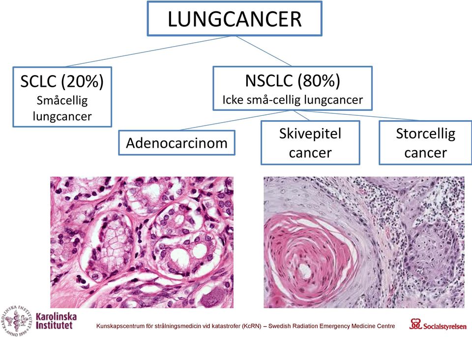 (80%) Icke små-cellig lungcancer