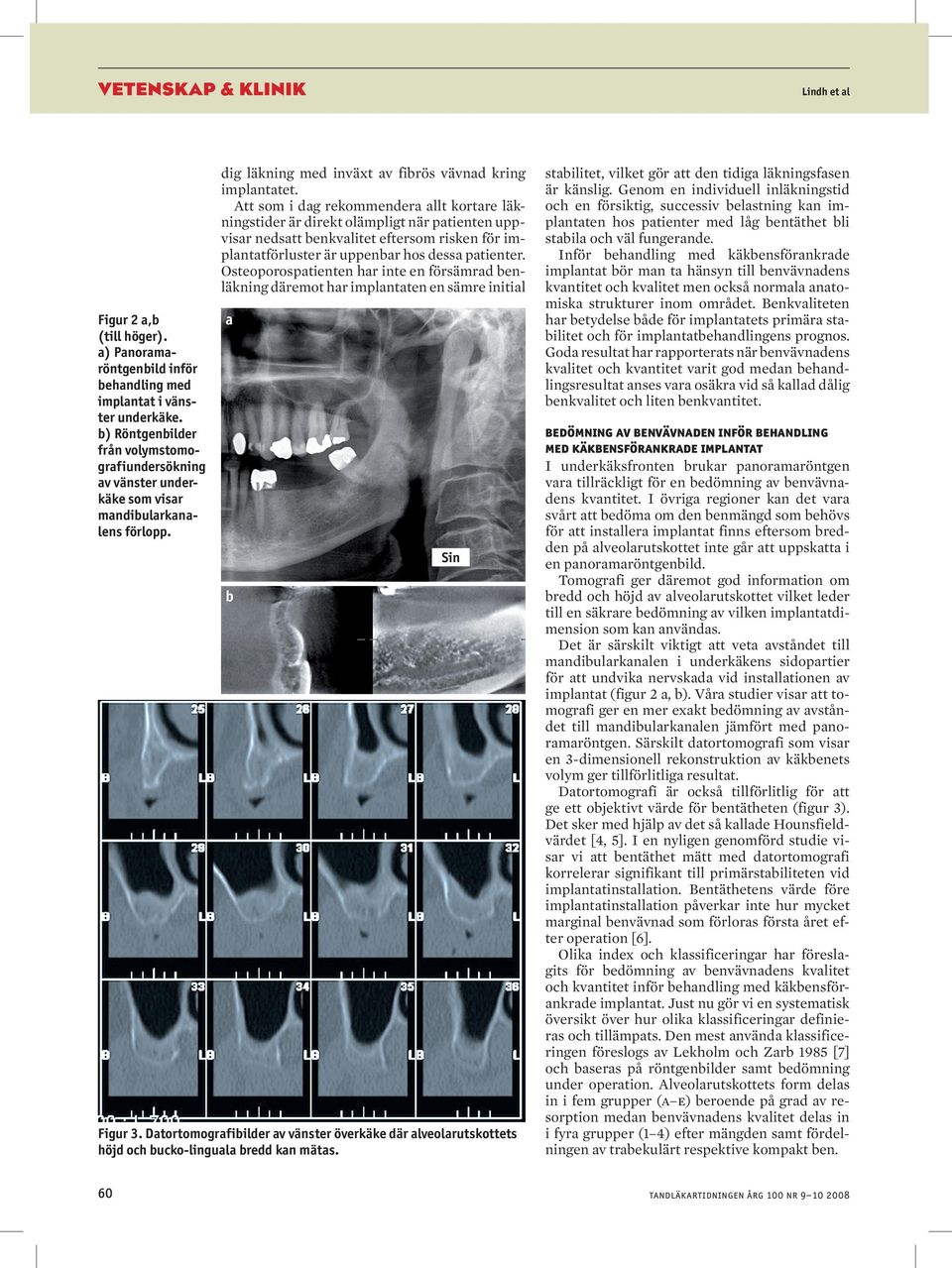 Osteoporospatienten har inte en försämrad benläkning däremot har implantaten en sämre initial Figur 2 a,b (till höger). a) Panoramaröntgenbild inför behandling med implantat i vänster underkäke.