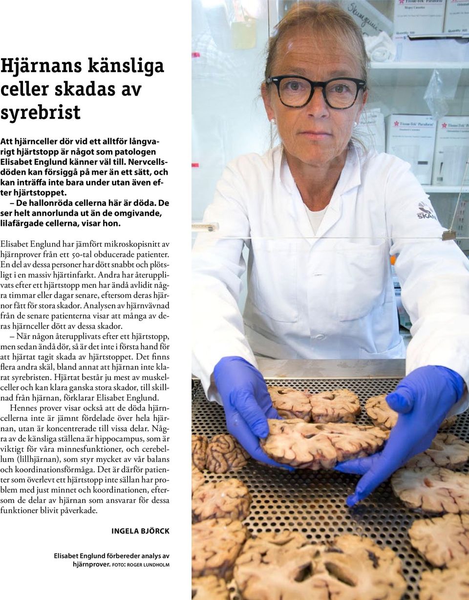 De ser helt annorlunda ut än de omgivande, lilafärgade cellerna, visar hon. Elisabet Englund har jämfört mikroskopisnitt av hjärnprover från ett 50-tal obducerade patienter.