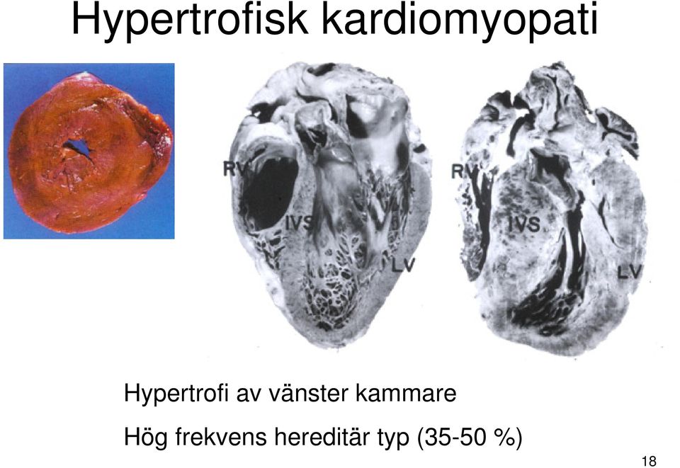 Hypertrofi av vänster