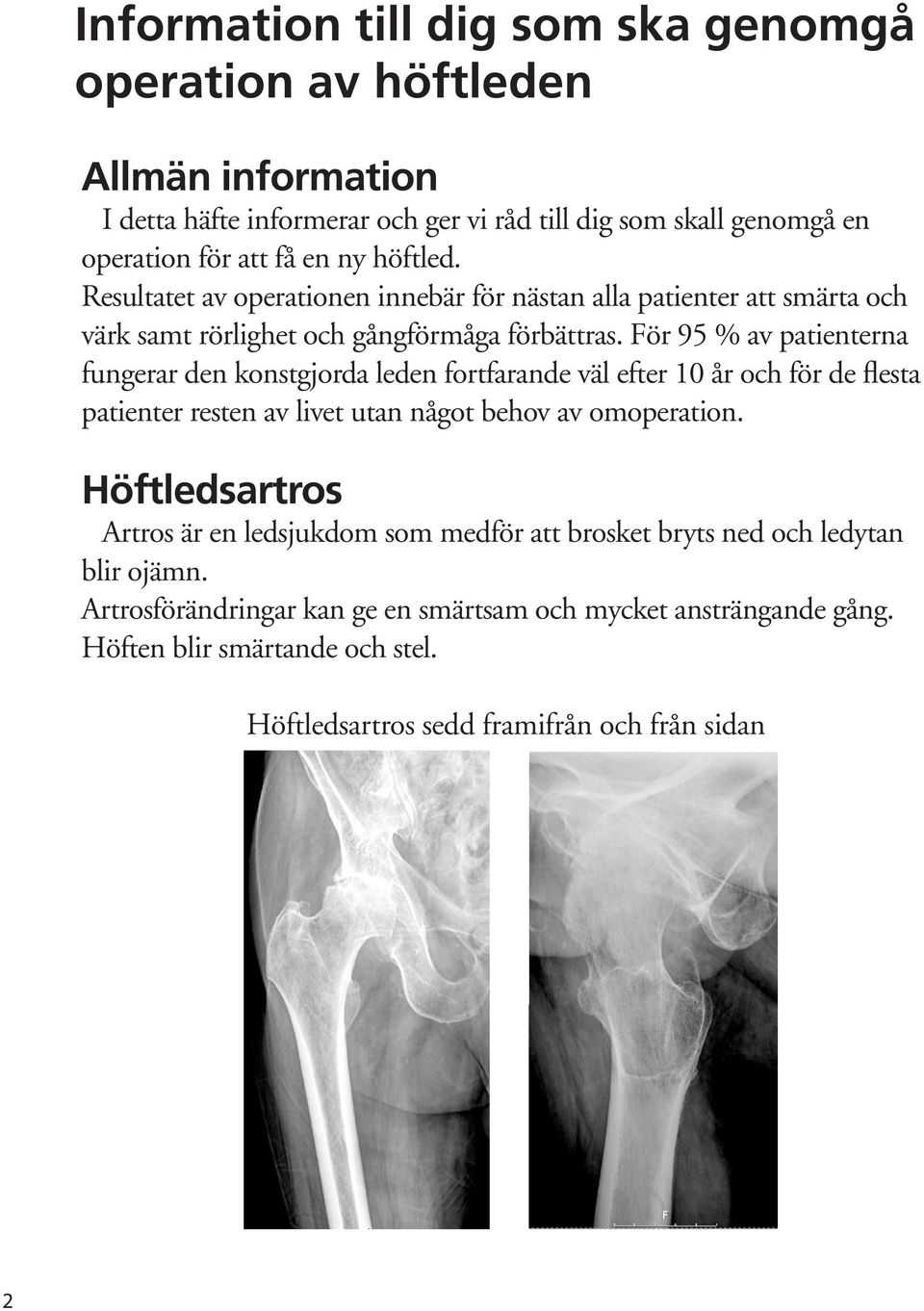 För 95 % av patienterna fungerar den konstgjorda leden fortfarande väl efter 10 år och för de flesta patienter resten av livet utan något behov av omoperation.