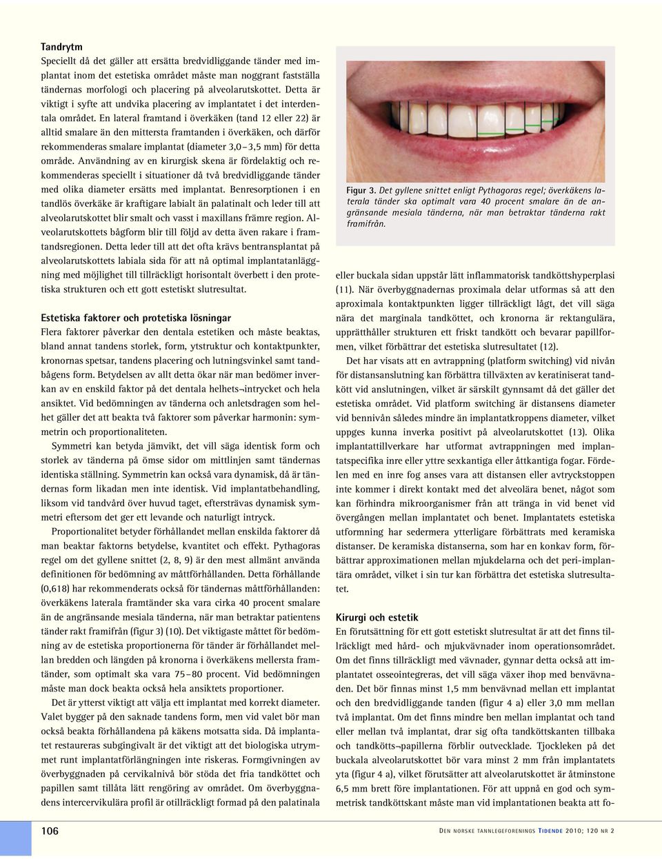 En lateral framtand i överkäken (tand 12 eller 22) är alltid smalare än den mittersta framtanden i överkäken, och därför rekommenderas smalare implantat (diameter 3,0 3,5 mm) för detta område.