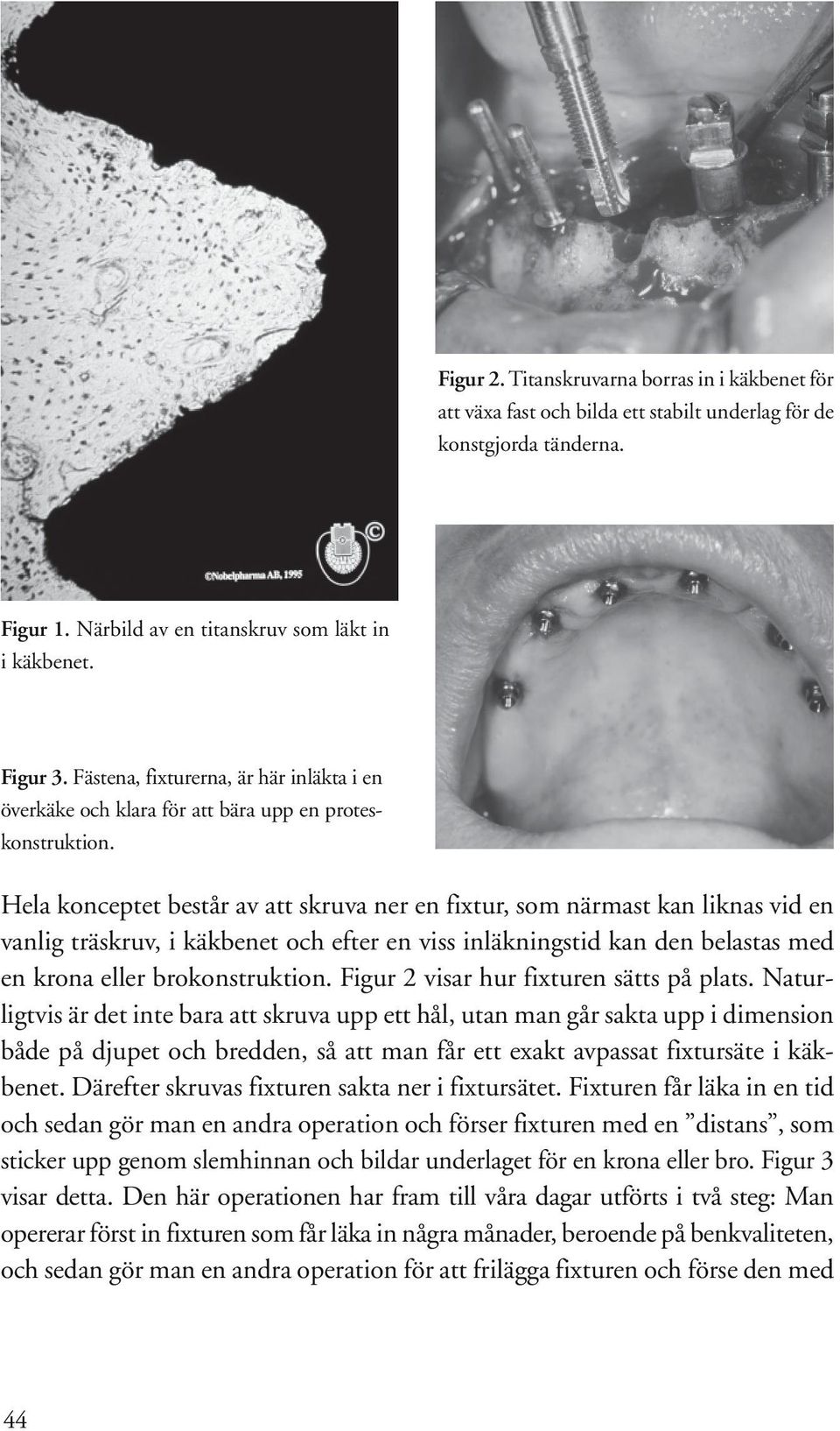 Hela konceptet består av att skruva ner en fixtur, som närmast kan liknas vid en vanlig träskruv, i käkbenet och efter en viss inläkningstid kan den belastas med en krona eller brokonstruktion.