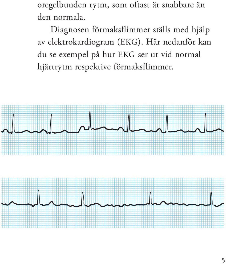 elektrokardiogram (EKG).