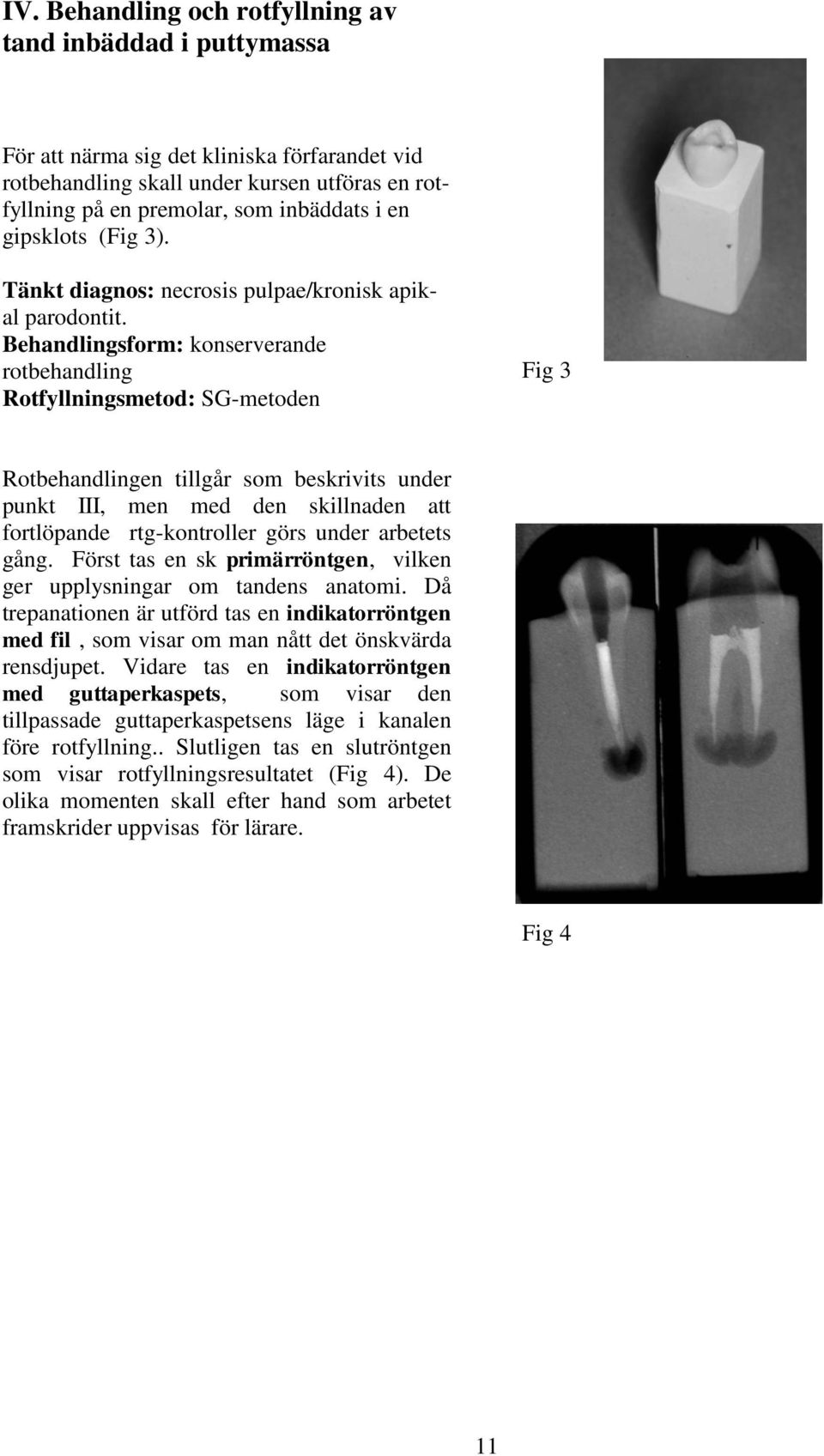 Behandlingsform: konserverande rotbehandling Rotfyllningsmetod: SG-metoden Fig 3 Rotbehandlingen tillgår som beskrivits under punkt III, men med den skillnaden att fortlöpande rtg-kontroller görs