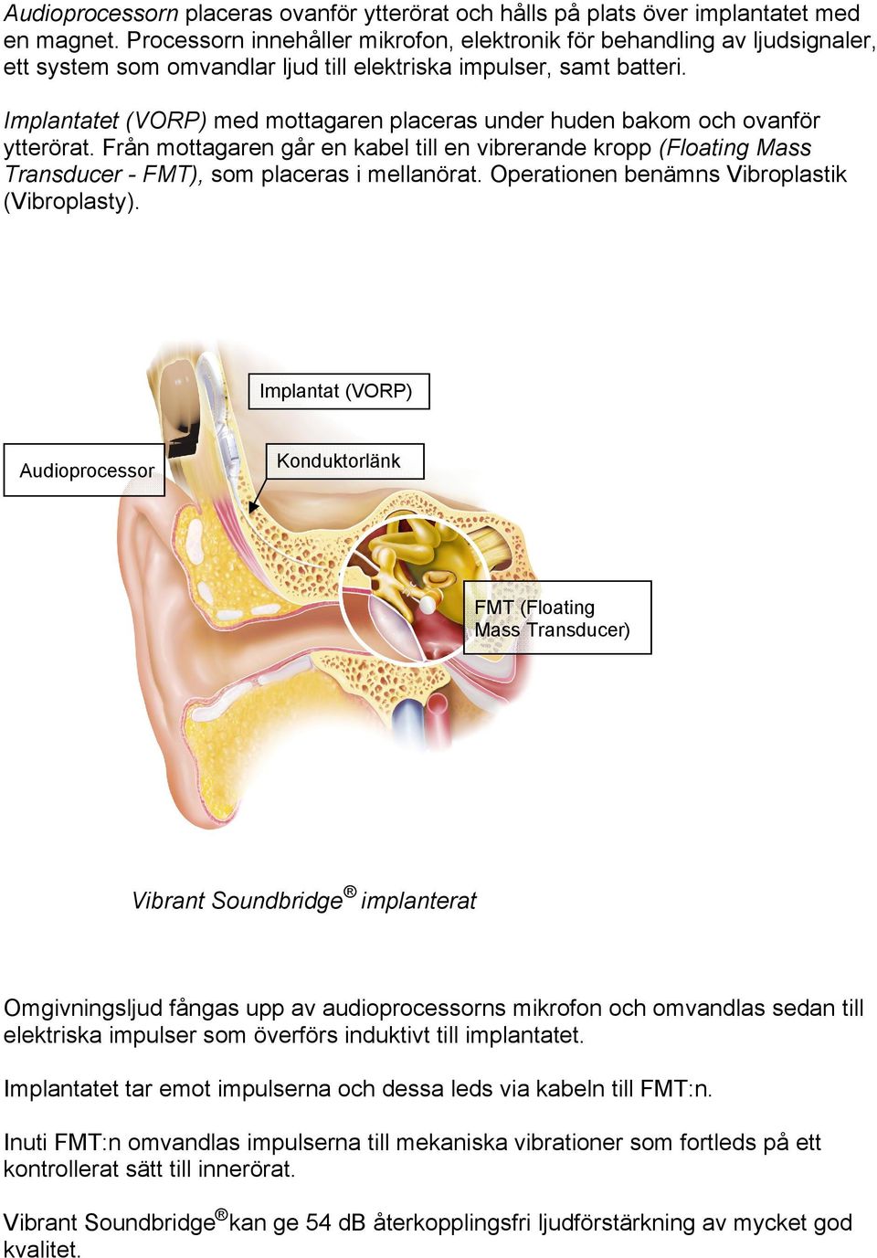 Implantatet (VORP) med mottagaren placeras under huden bakom och ovanför ytterörat. Från mottagaren går en kabel till en vibrerande kropp (Floating Mass Transducer - FMT), som placeras i mellanörat.