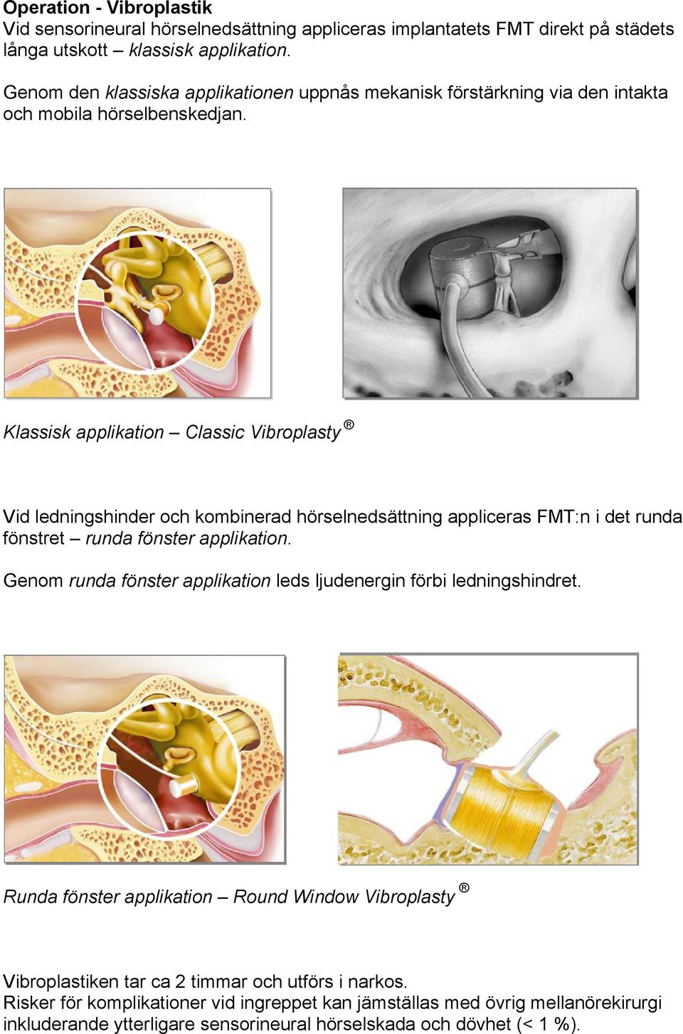 Klassisk applikation Classic Vibroplasty Vid ledningshinder och kombinerad hörselnedsättning appliceras FMT:n i det runda fönstret runda fönster applikation.