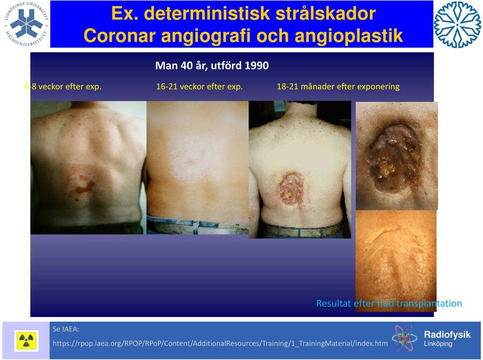 18 21 månader efter exponering Resultat efter hud transplantation Se IAEA: