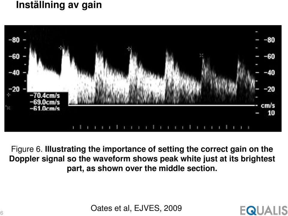 on the Doppler signal so the waveform shows peak white