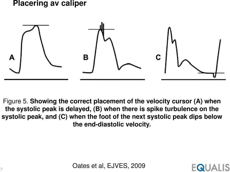 systolic peak is delayed, (B) when there is spike turbulence on the