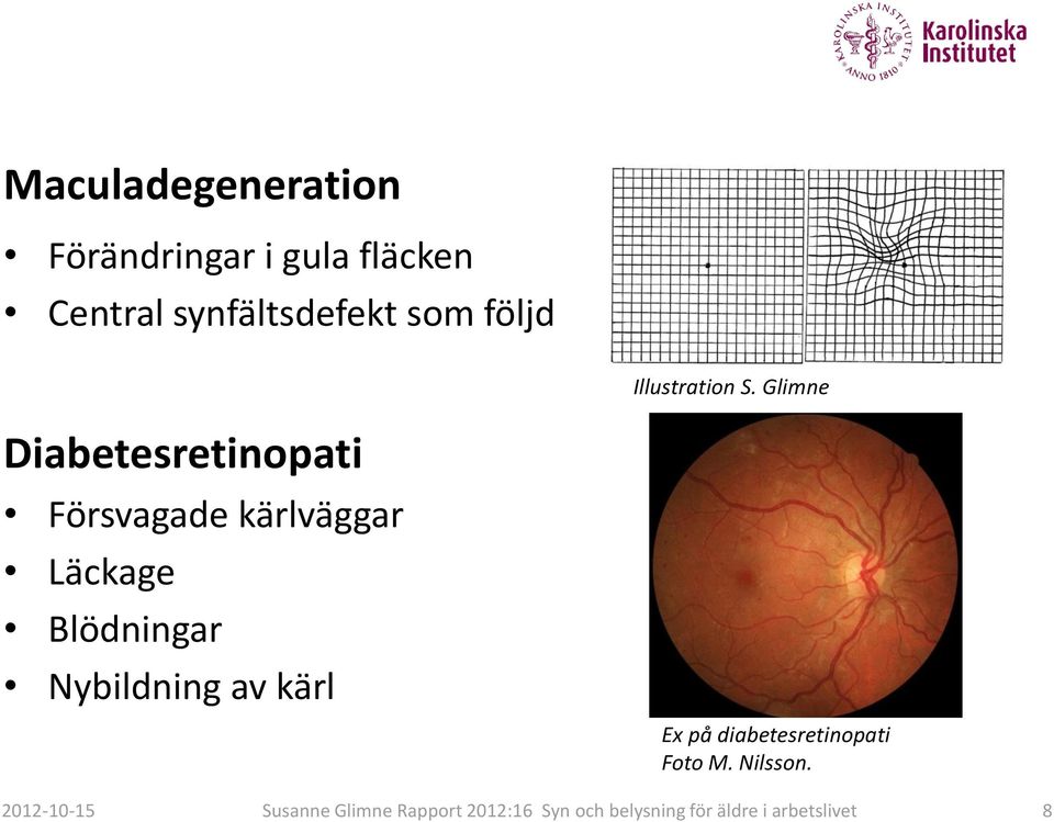 Glimne Diabetesretinopati Försvagade kärlväggar Läckage